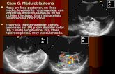 Caso 6. Meduloblastoma Masa en fosa posterior, en línea media, levemente heterogénea, con pequeñas lesiones quísticas en su interior (flechas). Gran hidrocefalia.