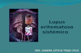 DRA. SANDRA LETICIA TREJO CRUZ. Lupus eritematoso sistémico Es una enfermedad autoinmune, inflamatoria crónica de etiología desconocida que afecta múltiples.