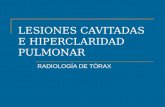 LESIONES CAVITADAS E HIPERCLARIDAD PULMONAR RADIOLOGÍA DE TÓRAX.