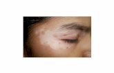 Leucoderma, cura para el vitiligo, como se cura el vitiligo, tipos de manchas en la cara