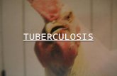 TUBERCULOSIS. Introducción Es una enfermedad contagiosa causada por Mycobacterium avium. Se caracteriza por su cronicidad, persistencia cuando se establece.