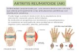 Artritis reumatoide (AR)
