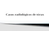 Casos radiológicos de tórax
