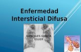 Enfermedad pulmonar intersticial difusa