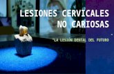 Lesiones cervicales-no-cariosas
