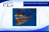 Dilaceracion radicular