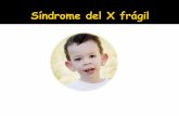 Sindrome del X Fragil