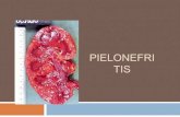 Pielonefritis y Glomerulonefritis