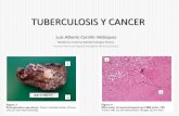 TUBERCULOSIS Y CANCER · PDF file• La TBC pulmonar se ha encontrado en el 0,7% de los casos de cáncer de pulmón. • La tuberculosis y el cáncer son dos procesos de enfermedad