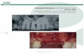 ImplantologíaMultidisciplinaria - Maxillaris - Revista del … · 2012-07-19 · Ortopantomografía que muestra la imagen quística en el maxilar superior, dientes 11 y 12. ... tar