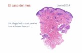 Un diagnóstico que vuelve con el buen tiempo - ADA de junio 2014 (castellano).pdf · Puede existir espongiosis, paraqueratosis, vacuolización basal y ocasional disqueratosis, pero