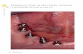 Tratamiento con prótesis fija sobre implantes ... · tesis fija sobre implantes mandibulares. Se realizó un estudio radiológico con ortopantomografía y 3D Cone Beam (CBCT), en