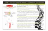 inyección epidural caudal lumbar de esteroidesesp.drzarembinski.com/articles/esppdf/Lumbar ESI Caudal 061606.pdf · inyección epidural caudal lumbar de esteroides Para Dolor de