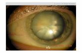 El cristalino es una lente - oftalmologiagipuzkoa.com · transparente que sirve para la acomodación . Con elbiomicroscopio se puede ver la catarata Sin catarata ... Tipos de cataratas: