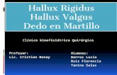 Hallux Rigidus Hallux Valgus Dedo en Martilloecaths1.s3.amazonaws.com/clinicakinefisiatricaunaj/183564916... · Se caracteriza por la desviación en varo del primer metatarsiano a