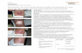 Resolución de una herida postraumática localizada … 20-06-07 se inicia tratamiento con IRUXOL®MONO (colagenasa) para eliminar los restos de tejido no viable del lecho de la herida