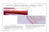 Lesiones pápulo-noduloides múltiples en pierna. Argent. Dermatol. 54(6... · tograma, perfil lipídico y proteinograma por elec-troforesis, dentro de parámetros normales. Se descartan