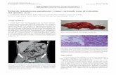Debut de cistoadenoma apendicular y tumor carcinoide como …scielo.isciii.es/pdf/diges/v109n2/es_imagenes2.pdf · 2017-06-12 · IMÁGENES EN PATOLOGÍA DIGESTIVA Debut de cistoadenoma