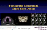 Tomografía Computada Multi-Slice Dentalcolibya.com/descargas/COLIByA-TCMS-11.pdf · •Lesiones inflamatorias •Lesiones traumáticas •Implantes de siliconas •Lesiones quísticas