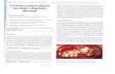 MFDICm.A Y ^ MFDICmE PATHOLOGY Carcinoma escamoso …diposit.ub.edu/dspace/bitstream/2445/100674/1/520912.pdf · remedando lesiones inflamatorias que afectan la encía y el periodonto,