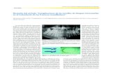 Discusión del artículo “Complicaciones de los …scielo.isciii.es/pdf/maxi/v30n4/clinico3_discusion.pdftiempo quirúrgico, también el poder colocarlos mediante anestesia local