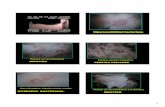 Lesiones 6 slides por paginaelearning.up.pt/ppayo/MCAC DERMA 15-16/PROGRAMA/PDF AULAS... · 2012-12-22 · 1 Hipersensibilidad bacteriana Pústulas con aro eritematoso IMPETIGO Pústulas