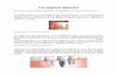 Un implant dentaire - Cabinet dentaire Lyon Estselarl-blomart-avenir-odontologique.chirurgiens-dentistes.fr/... · Un implant dentaire est assimilable à une racine artificielle.