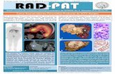 Tumor Neuroendócrino Pancreático Productor de ACTH Maligno · 2018-08-03 · 1. Kondo T, et al. A Case of Ectopic ACTH-producing Pancreatic Neuroendocrine Tumor with Multiple Liver