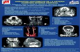 Giribet A., Delgado B., Lloris A., Carrillo A., Sánchez F ...amorl.es/images/pdf/posters/variantes_anatomicas...VARIANTES ANATOMICAS DE LA ARTERIA CAROTIDA INTERNA CERVICAL. HURyC