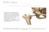 Reemplazo parcial de cadera - Instituto Penta de ...traumatologiapenta.com.ar/docs/pacientes/cadera... · Reemplazo parcial de cadera Un reemplazo parcial de cadera es un procedimiento