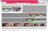 Mastectomía por patología benigna, tumoración mamaria en ... · Tercera cirugía: retoque de adaptación de colgajo dorsal. Resultado final: I Conclusiones: -la patología benigna