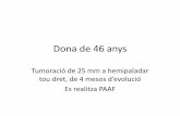 Dona de 46 anys · 2017. 5. 12. · Dona de 46 anys Tumoració de 25 mm a hemipaladar tou dret, de 4 mesos d’evolució Es realitza PAAF