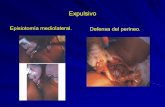 Episiotomía mediolateral. Defensa del perineo.