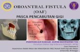 OROANTRAL FISTULA (OAF)