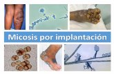 Micosis por implantación